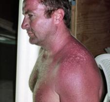 carolina jim sunburned arms shoulders